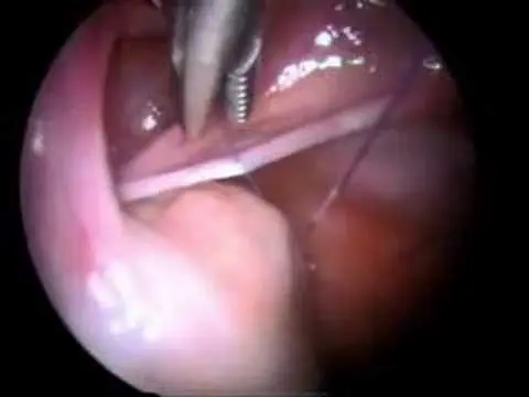 Ovarian torsion - Yumurtalık Dönmesi
